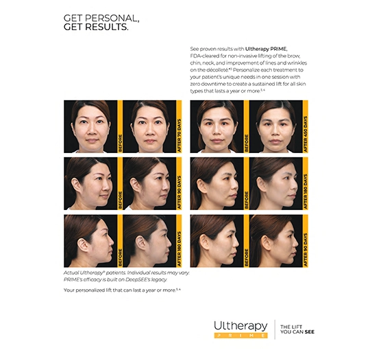 Ultherapy Prime brochure image 4